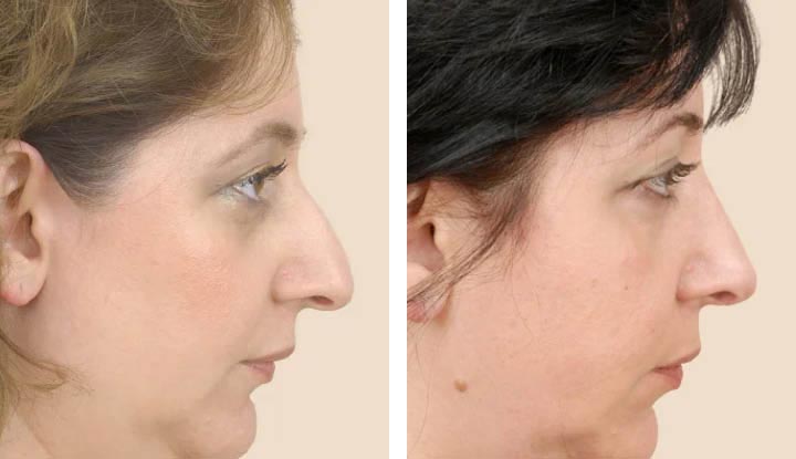 Nose Surgery: Enhancing Aesthetics and Functionality